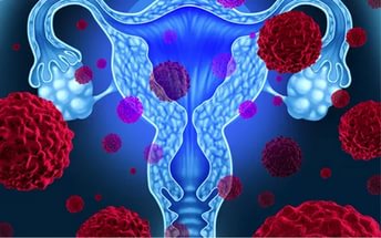 <h1>Симптомы рака яичников</h1>
<h4>Это одно из самых встречаемых онкологических женских заболеваний</h4>